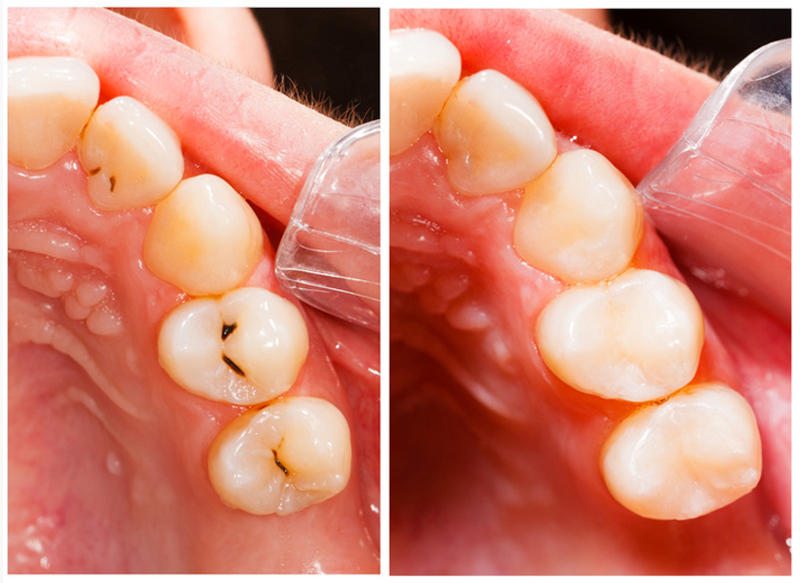 Fillings Redondo Beach, CA