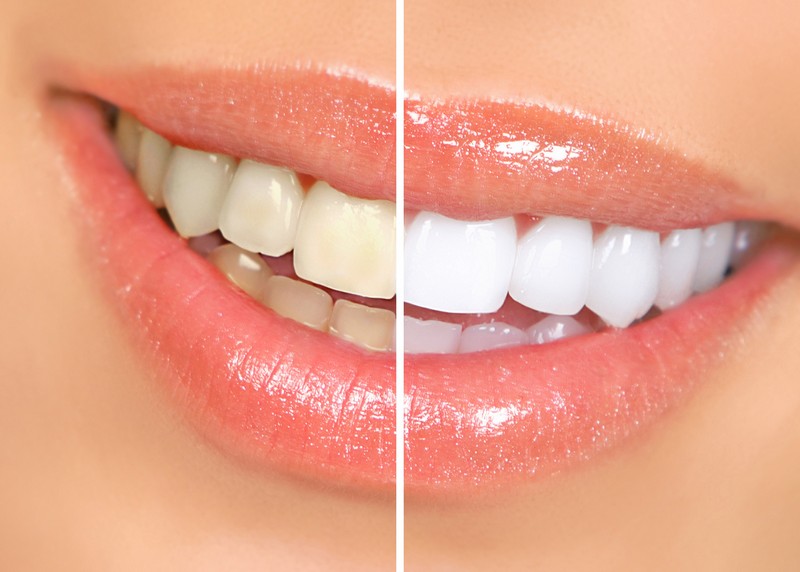 Teeth Whitening Redondo Beach, CA 