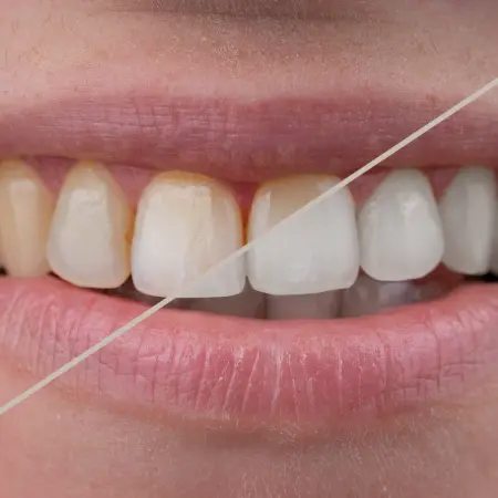 Choosing the Right Professional Teeth Whitening Brand: Why KöR Stands Out From All the Rest